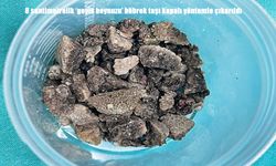8 santimetrelik 'geyik boynuzu' böbrek taşı kapalı yöntemle çıkarıldı