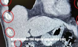 Midelerinden 136 kapsül uyuşturucu çıktı