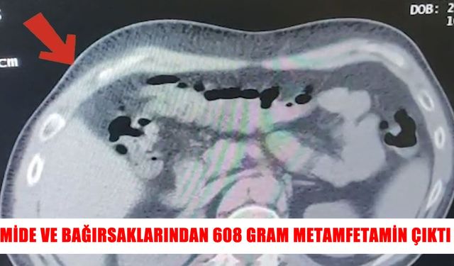 Otobüste yakalandı, mide ve bağırsaklarından metamfetamin çıktı